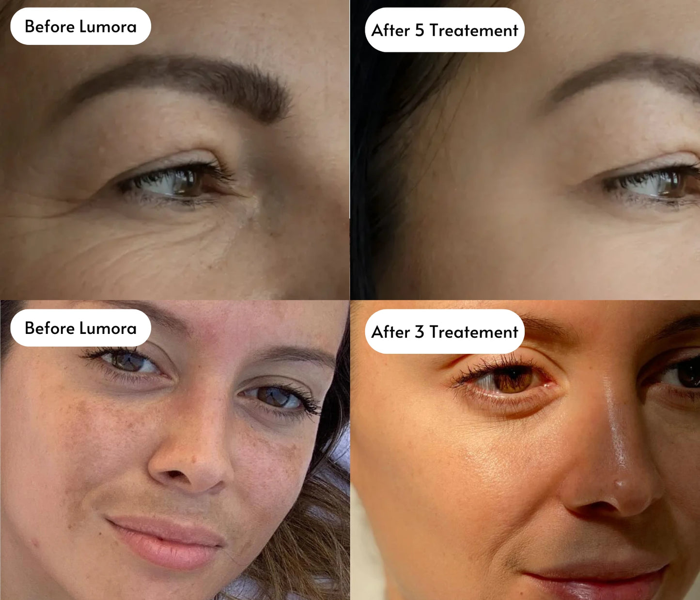 Lumora Micro-infusion System ™ - Transform dull looking skin